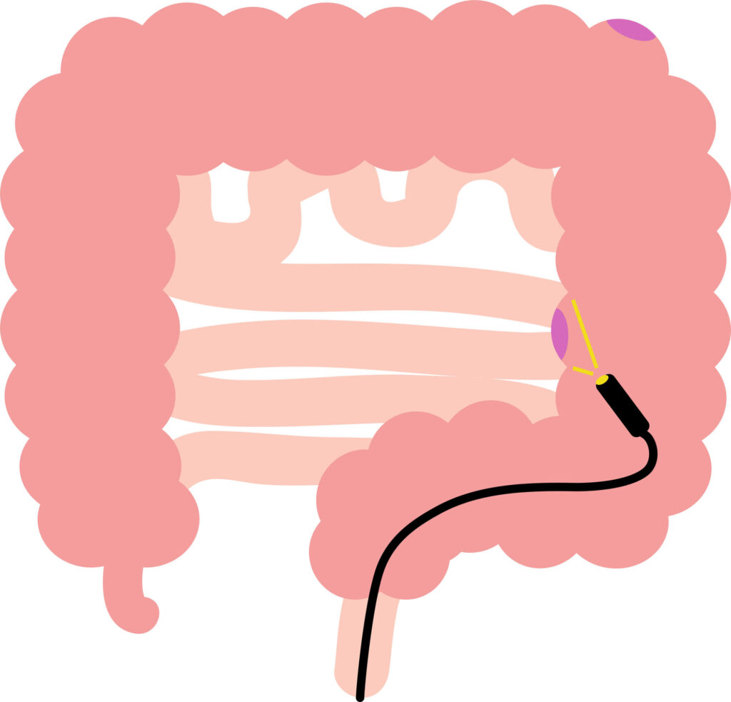 大腸カメラとは？