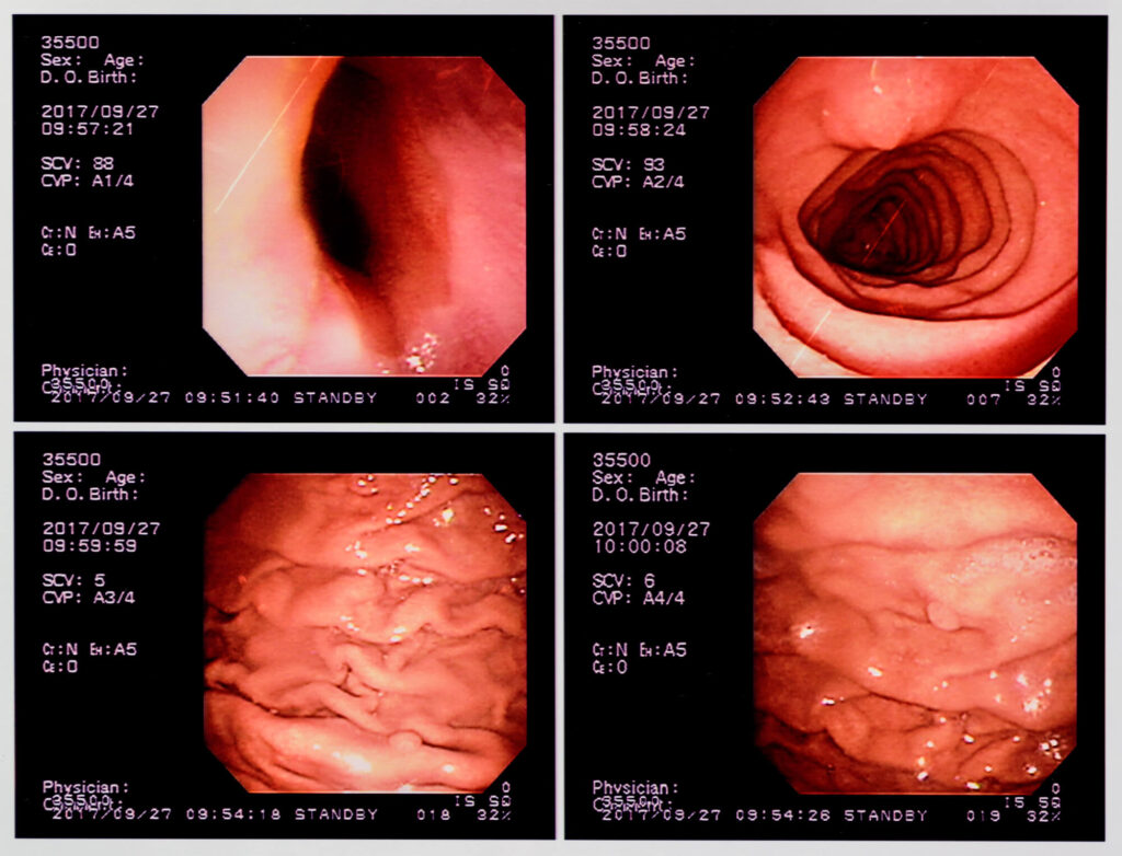 胃カメラ検査のメリットとデメリット