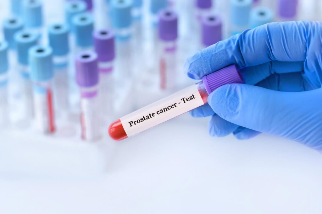 PSA検査の検査方法と前立腺がん検査全体の流れ