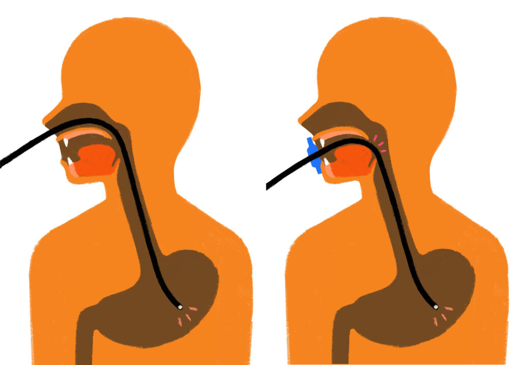 胃カメラで楽なのは一般的に「鼻から」